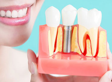 Dental Implant Services in India