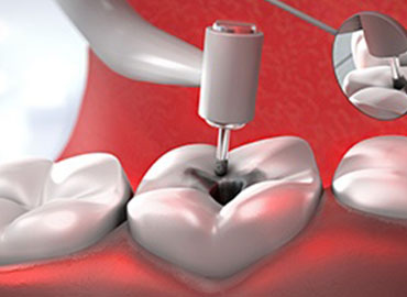 Pain Free Root Canal Treatment in India