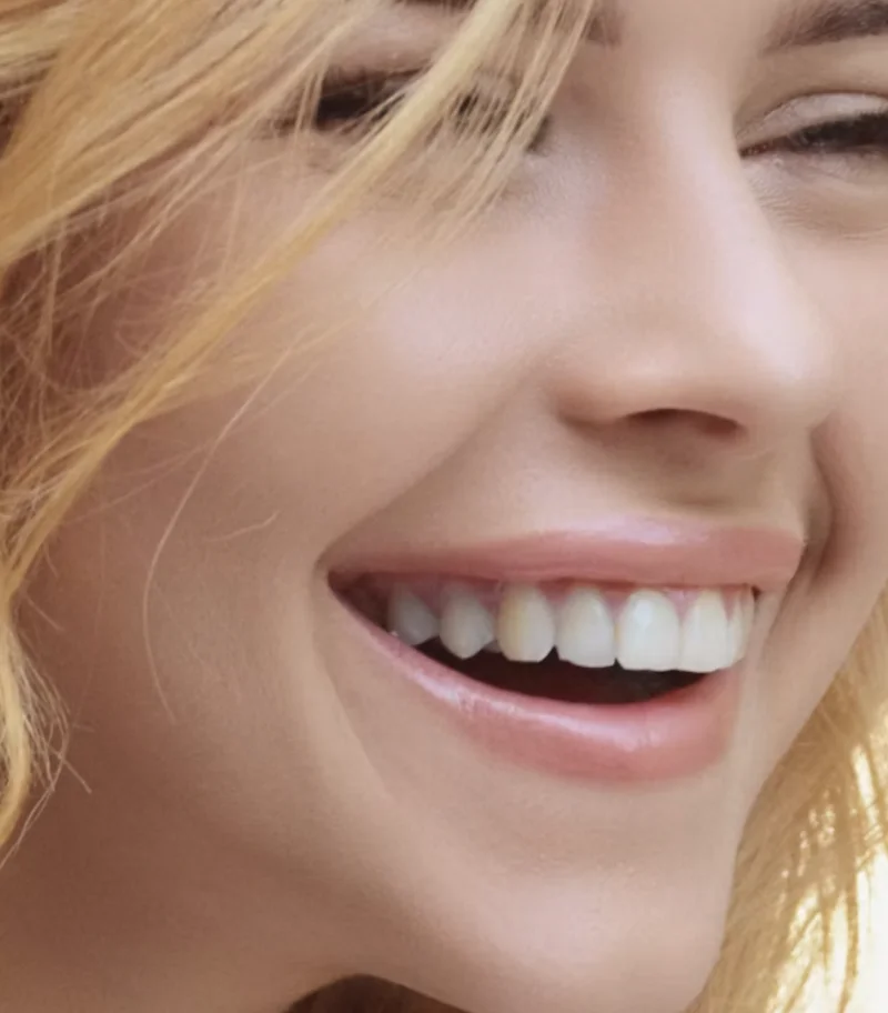 Hollywood Smile Makeover -  Dentally