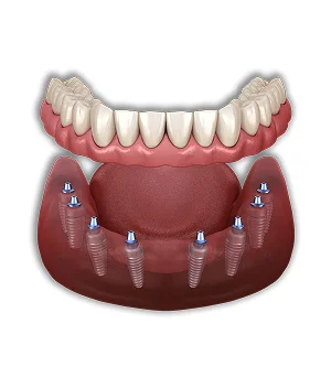 All-on-8 Dental Implants in Delhi, India -  Dentally