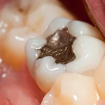 TMJ TREATMENT -  Dentally