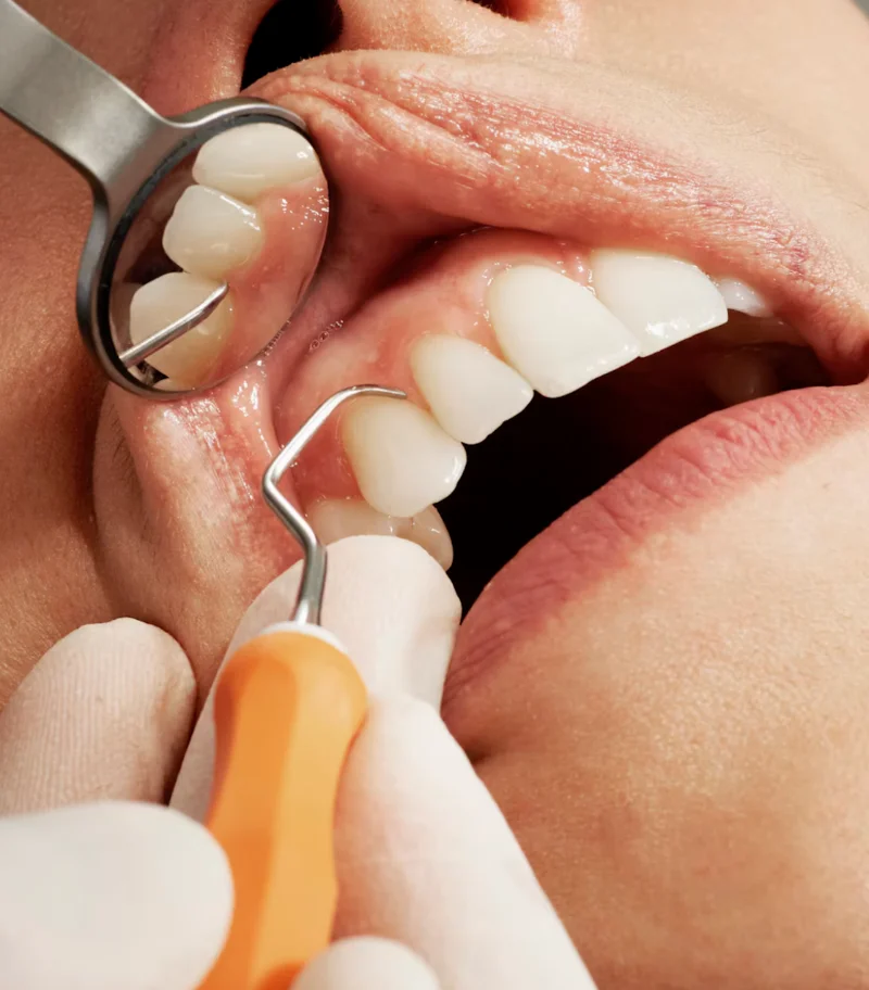 Painless Teeth Cleaning and Polishing -  Dentally