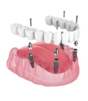All-on-4 Dental Implants and Same-Day Teeth: Types, Costs and Treatment Options -  Dentally
