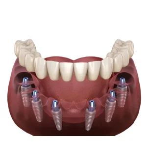 Reclaim Your Natural Smile with Confidence: All-on-6 Dental Implants in Delhi -  Dentally