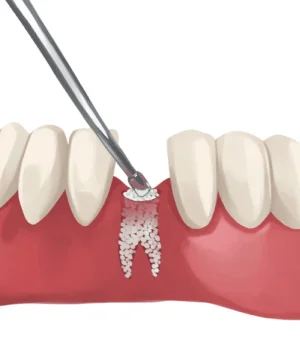BONE GRAFTING -  Dentally
