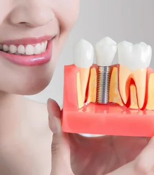 All-on-6 Dental Implants Cost in Delhi