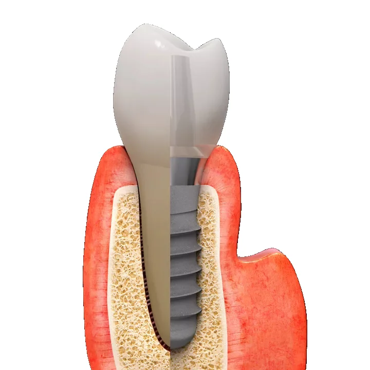 Straumann Implant Cost in India -  Dentally