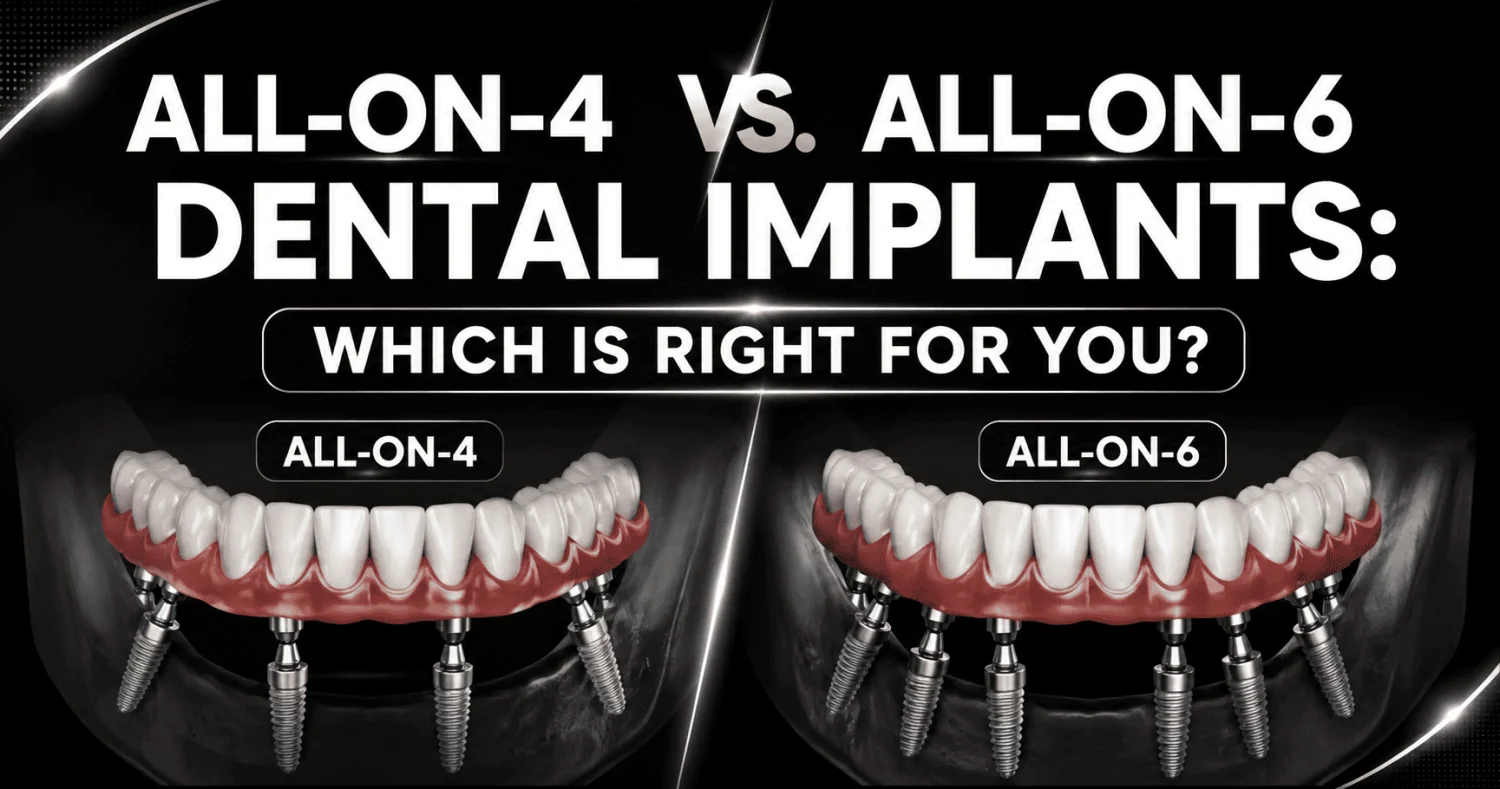 All-on-4 vs All-on-6 Dental Implants: Which Is Right for You? -  Dentally