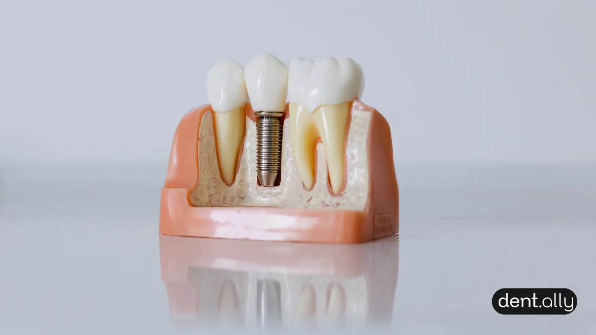 Can You Get a Dental Implant Years After Losing a Tooth? The Complete Guide -  Dentally