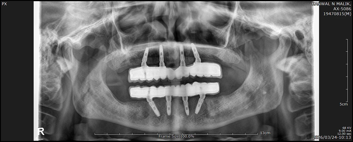 All-on-4 Dental Implants in Gurgaon, India