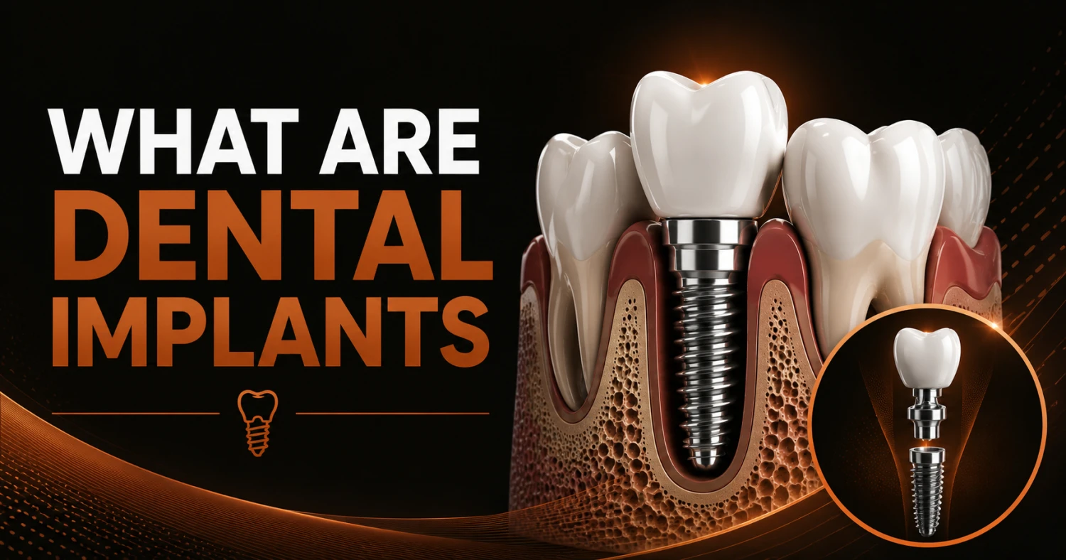 What Are Dental Implants