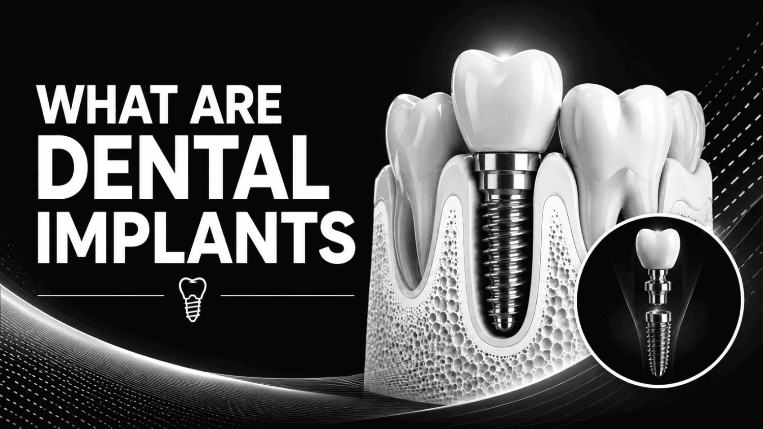What Are Dental Implants
