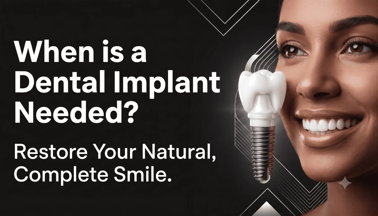 When is dental implants needed