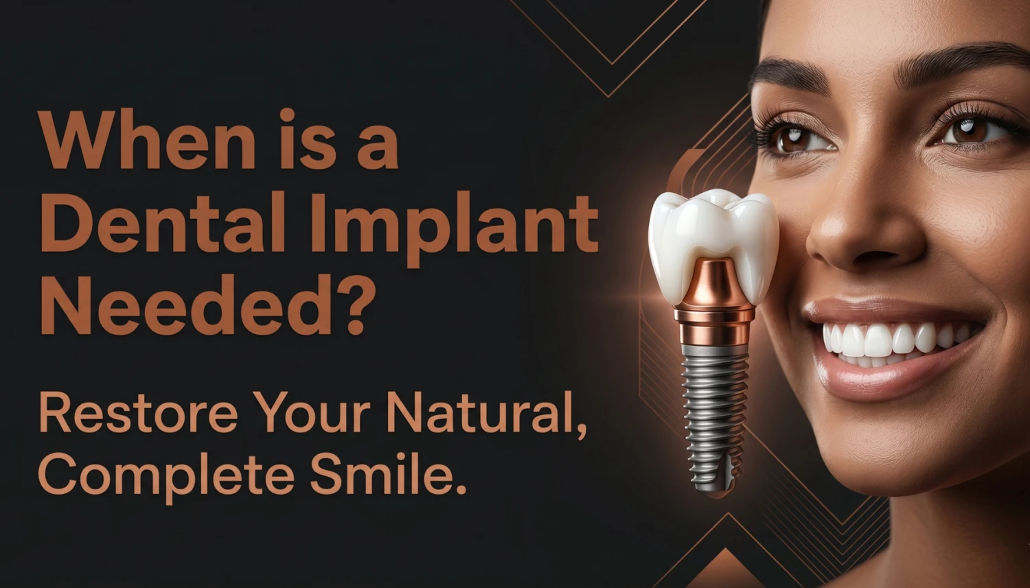 What Are Dental Implants