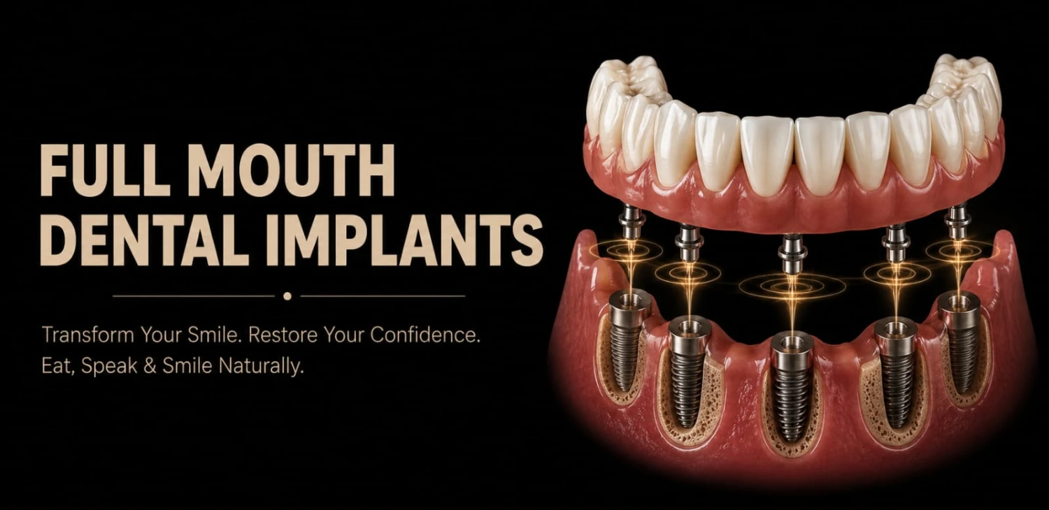 Full Mouth Dental Implants in Delhi, India