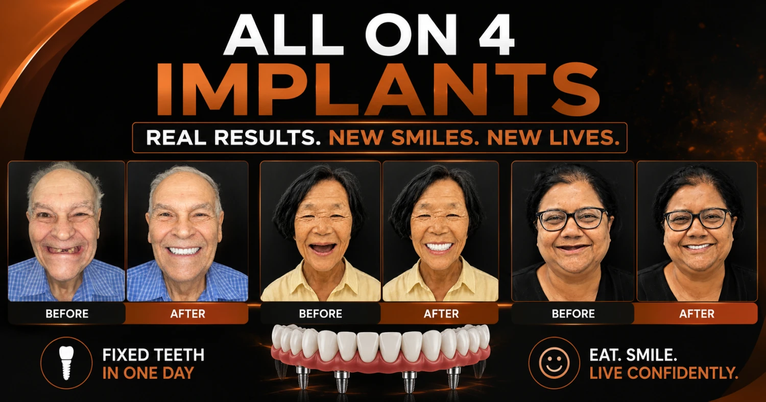 All-on-4 Dental Implants in Gurgaon