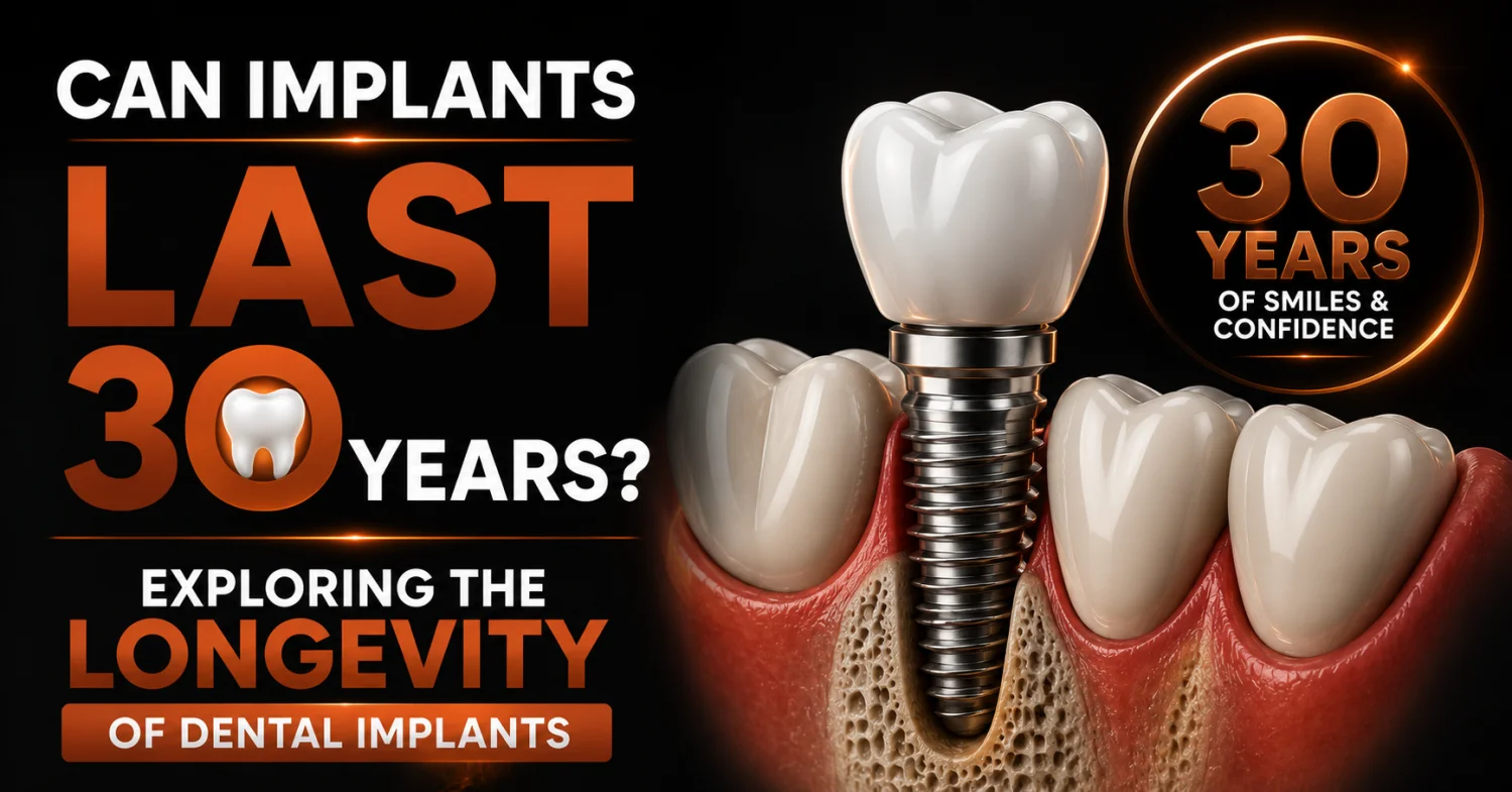 Dental Implant Longevity: Can They Last 30 Years? | Dentally -  Dentally