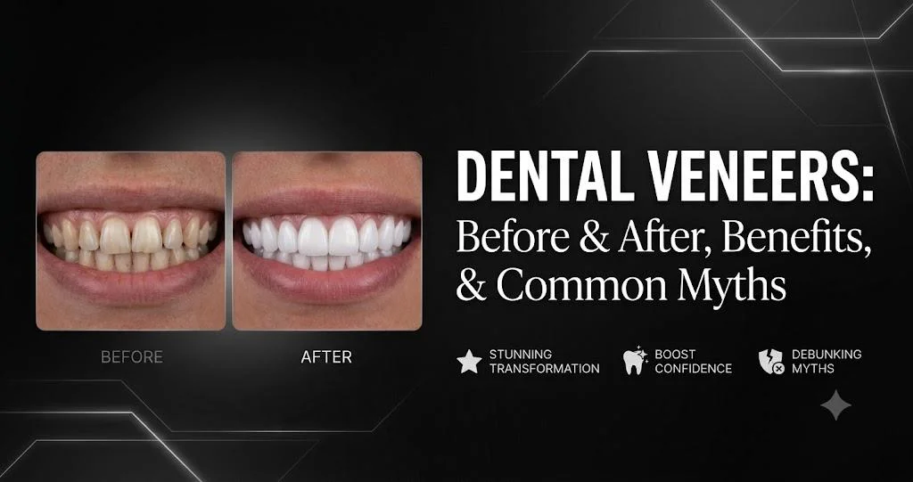 Dental Veneers: Before & After, Benefits, and Common Myths -  Dentally
