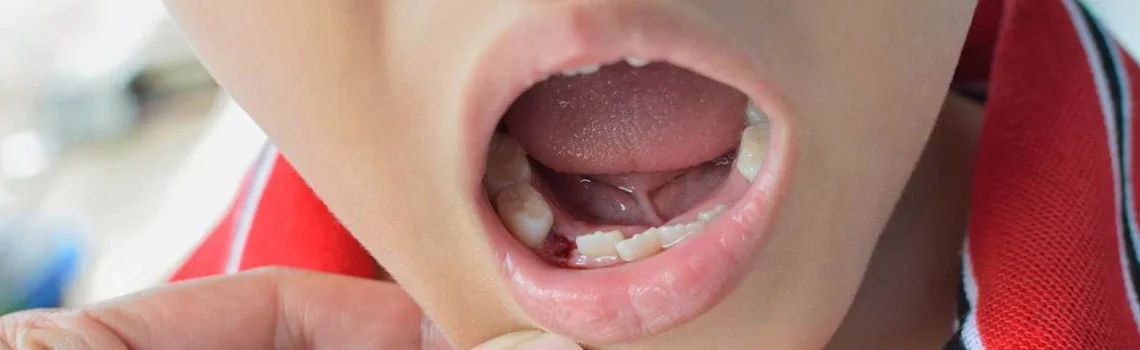 Do’s and Don’ts Post A TOOTH EXTRACTION, Best tooth extraction in Delhi -  Dentally