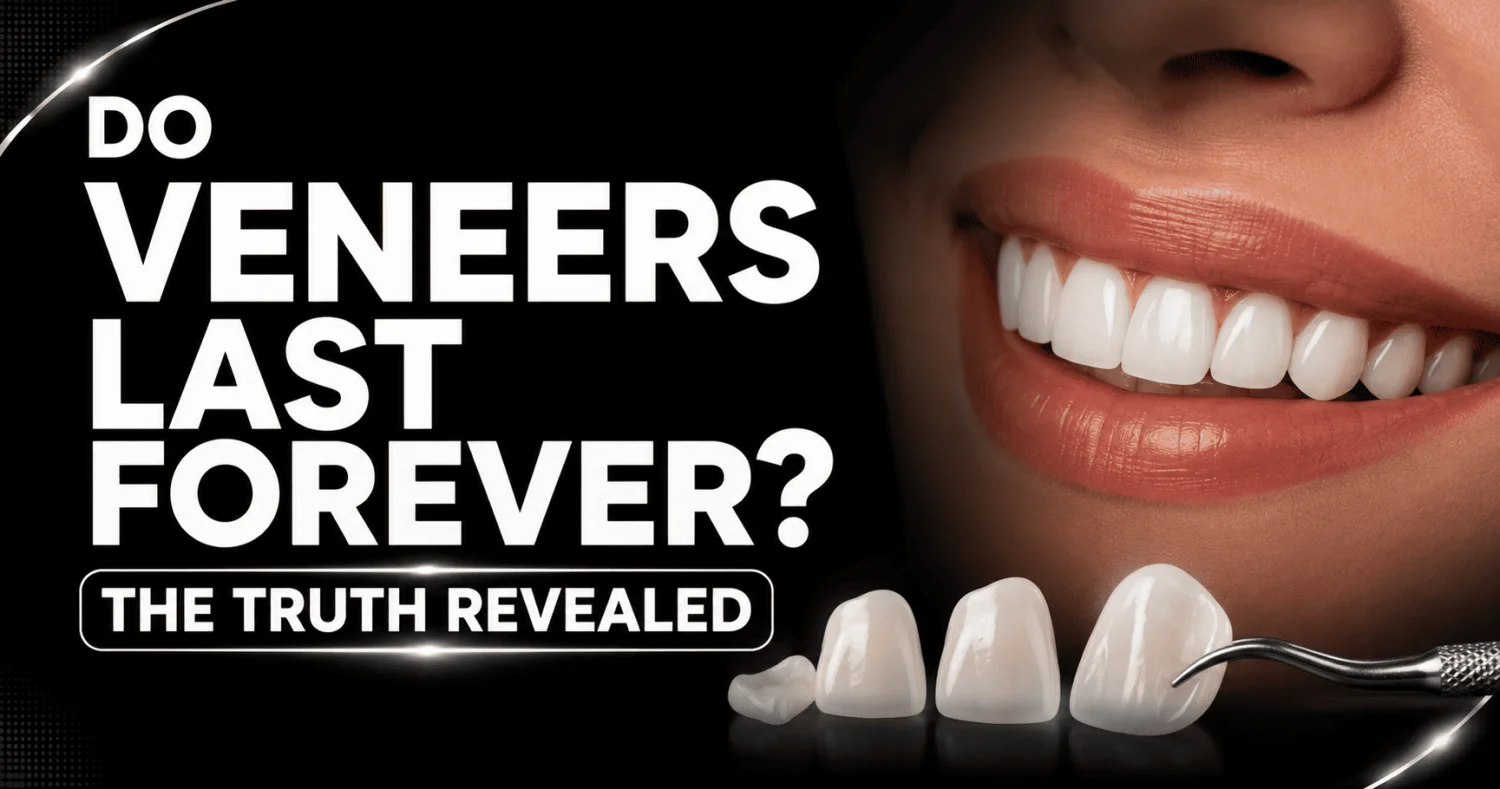 How Long Do Veneers Really Last? -  Dentally