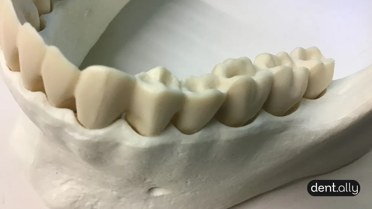 The Hidden Link: How Dental Implants Preserve Jawbone Health and Prevent Facial Collapse -  Dentally