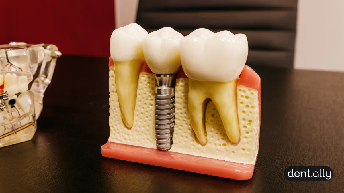 Zirconia vs. Titanium Implants: Which is the Best Biocompatible Choice for Your Smile? -  Dentally