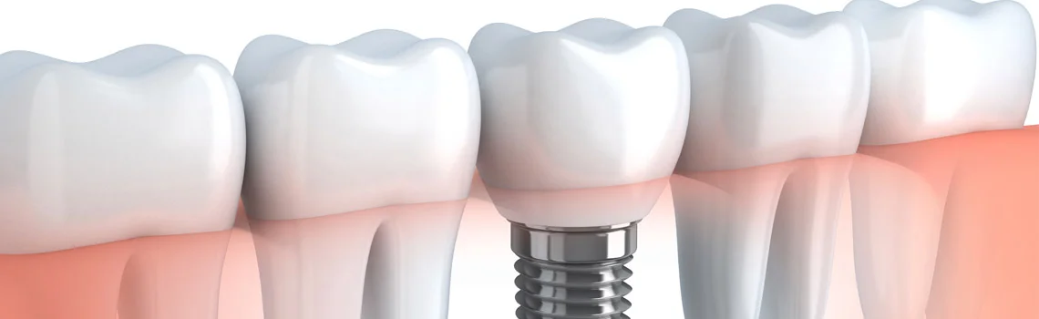 DENTAL IMPLANTS: WHY, WHEN AND HOW? -  Dentally