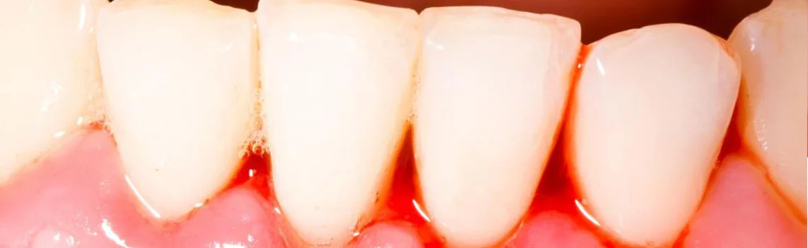 Bleeding Gums - What To Do? -  Dentally