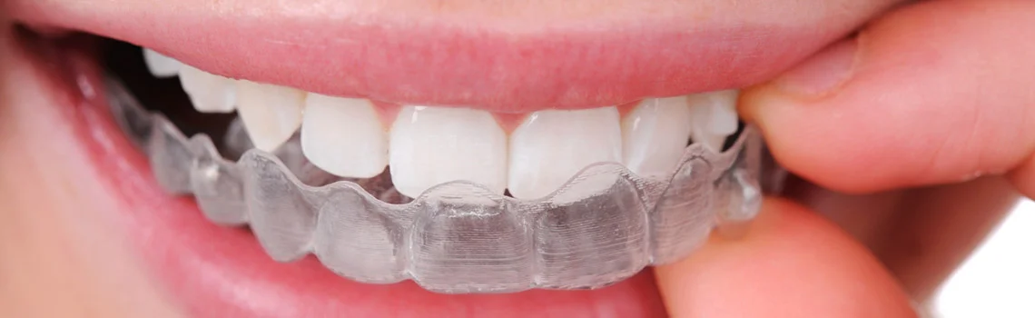 Invisible Braces -  Dentally