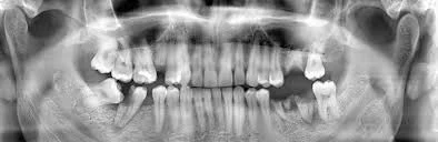 Have Missing Teeth? Here is all that you need to know about getting the smile you wanted. -  Dentally