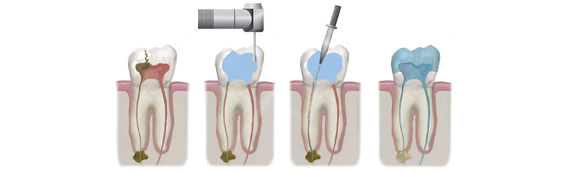 Root Canal Treatment is Not Painful, Not getting It Done is! -  Dentally
