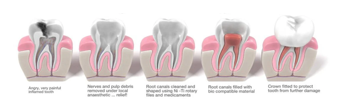Confused between when to go in for a filling or a root canal? -  Dentally