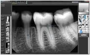 FULL MOUTH X-RAY