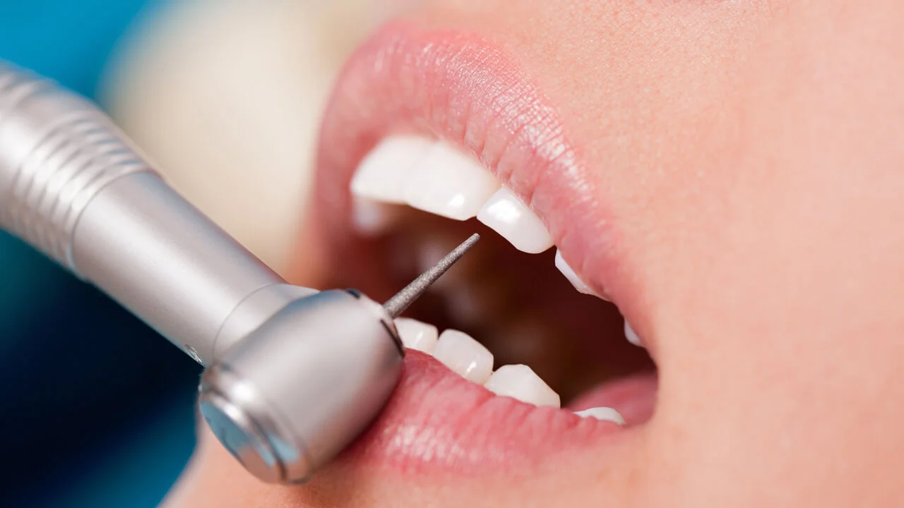 Do’s and Don’ts Post Root Canal Treatment, Best Root Canal Treatment in Delhi -  Dentally