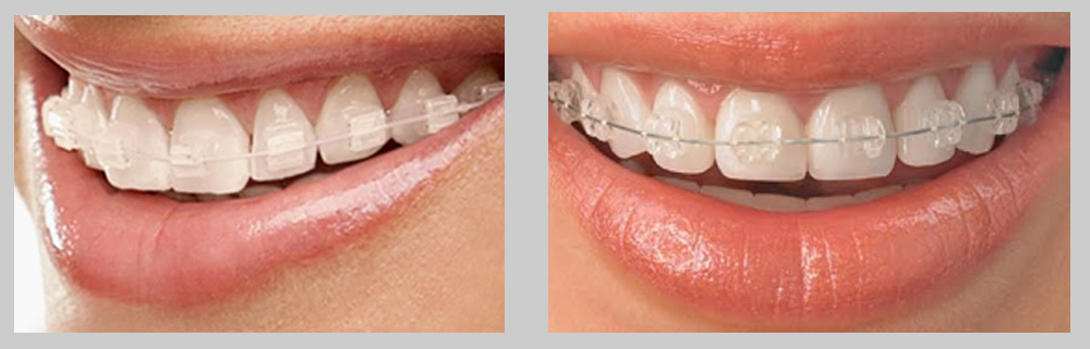 Metal braces: types, cost, and how they work 🦷