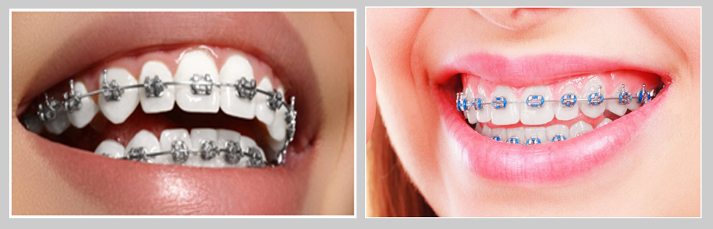 Different Types of Braces and their Costs - Dent Ally