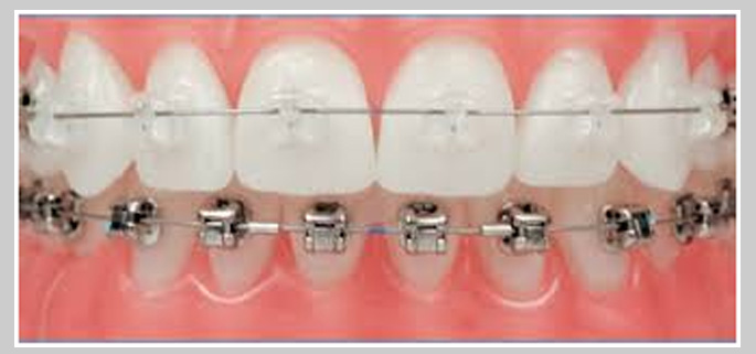Ceramic Braces Treatment Cost in Gurgaon, Dental Braces Cost in Gurgaon