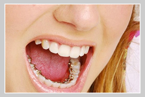 Dental Braces cost in India