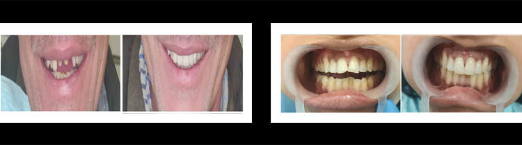 dental implants Delhi
