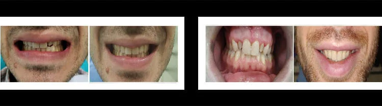 A Glimpse of Dental Implants Benefits -  Dentally