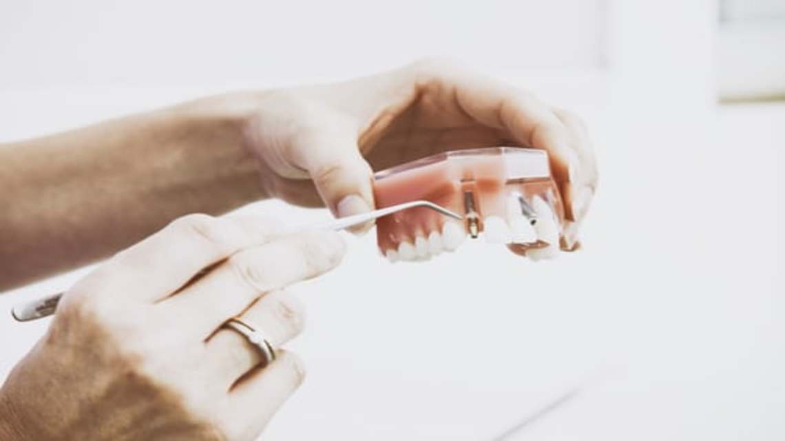 dental-implants-India