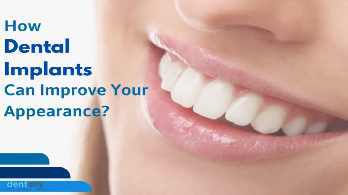 How Dental Implants Can Also Improve Your Appearance? -  Dentally