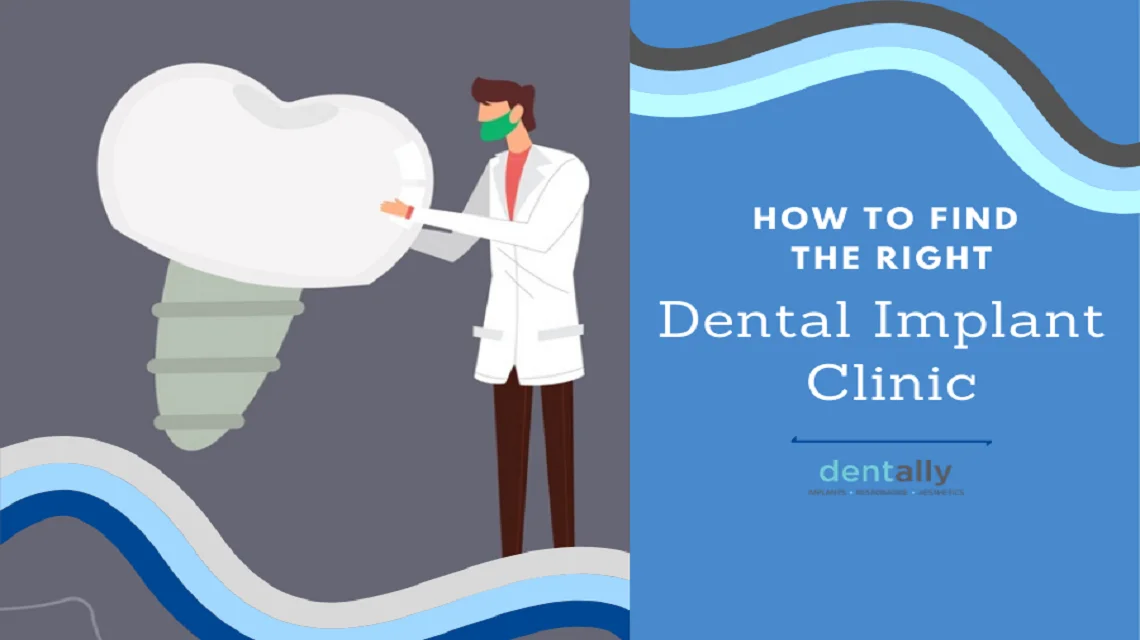 How To Find The Right Dental Implant Clinic? -  Dentally