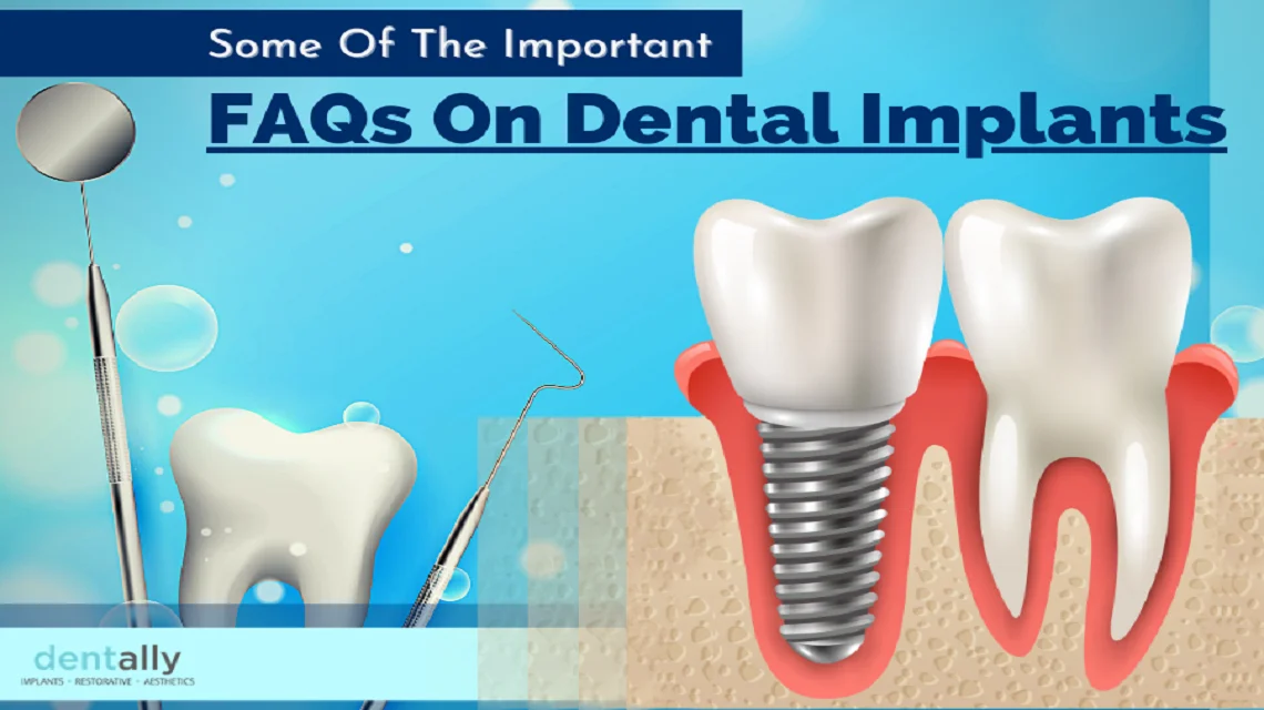 Some Of The Impotant FAQs On Dental Implants -  Dentally