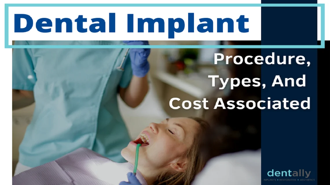 Dental Implant – Procedure, Types, And Cost Associated -  Dentally