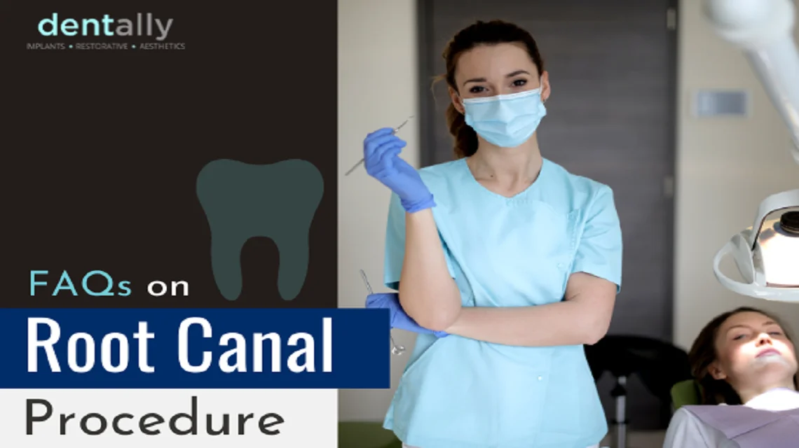 FAQs On Root Canal Procedure -  Dentally