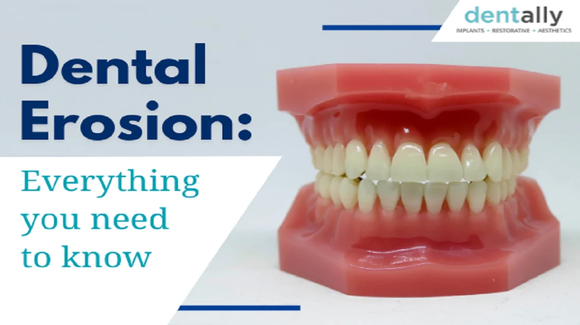Dental Erosion: What You Need To Know -  Dentally