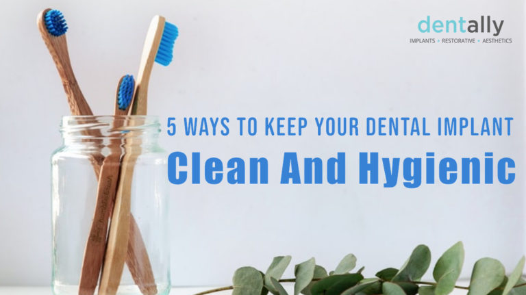 5 Ways To Keep Your Dental Implant Clean And Hygienic - Dent Ally