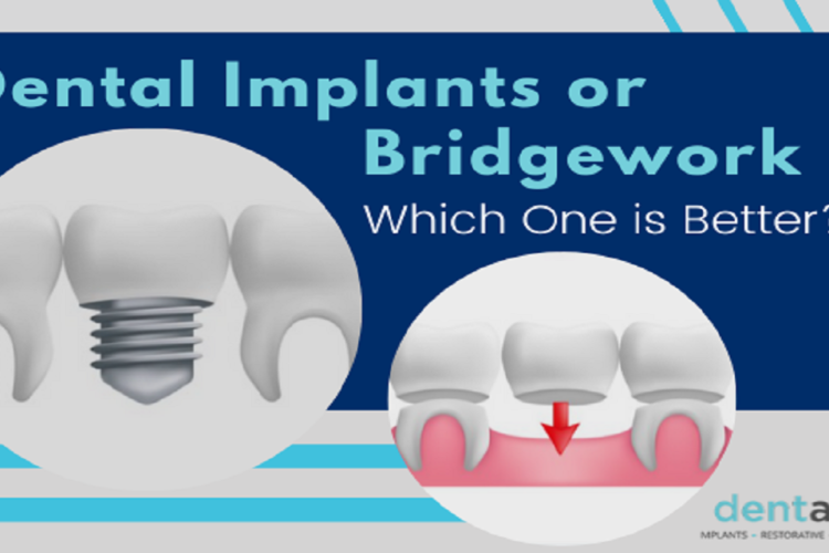 dental-implants-doctor-in-delhi