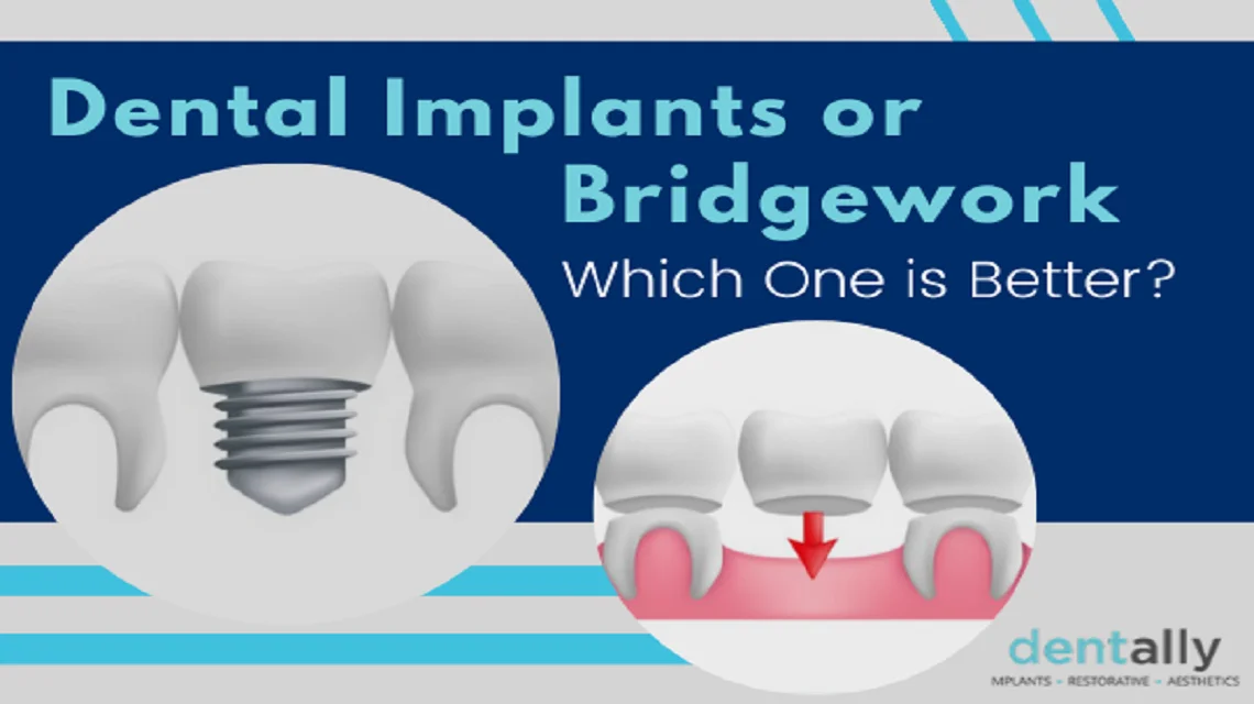 Dental Implants Or Bridgework – Which One Is Better? -  Dentally